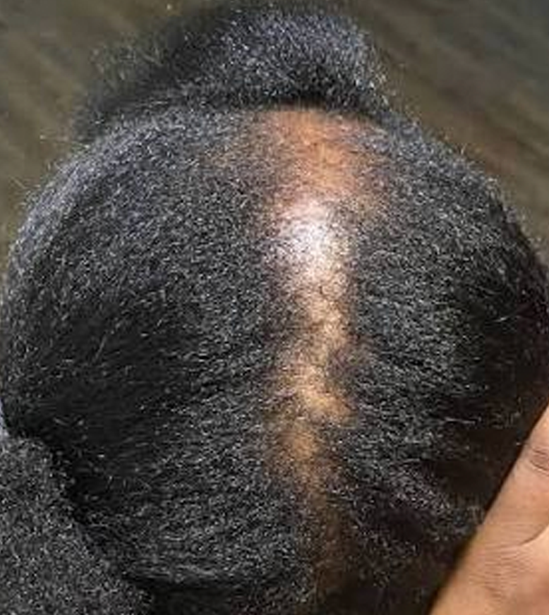 Understanding Alopecia: 8 Common Types of Hair Loss